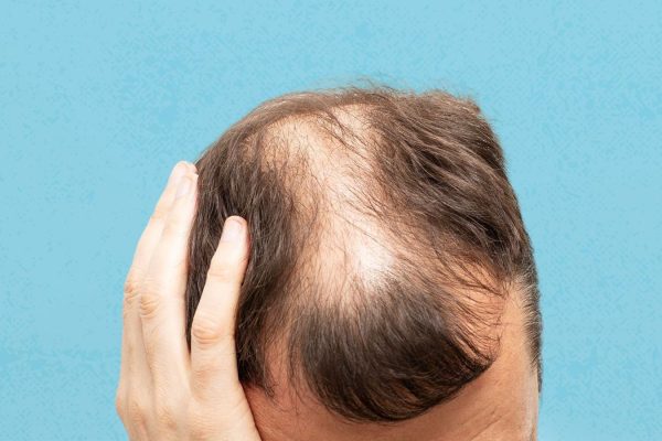 From Beard to Brows – Surprising Areas Where Hair Transplants Work